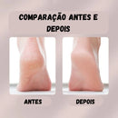 Smooth Forever V.2 - REMOVEDOR DE CALOS E RACHADURAS DOS PÉS [Ganhe +1 lixa de Quartz]| FRETE GRÁTIS HOJE